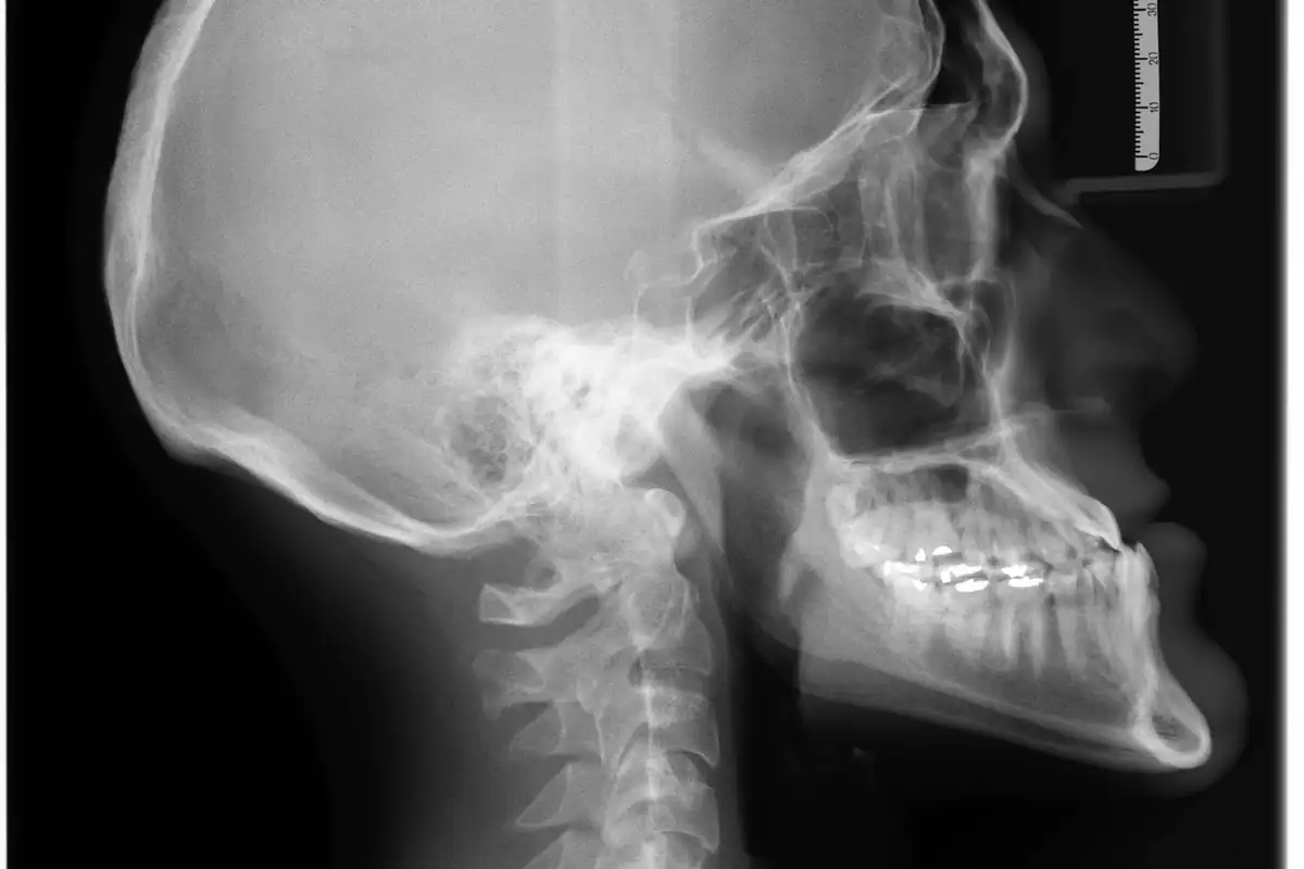 Radiografie laterală a craniului, cu aparat dentar fix vizibil pe dinți